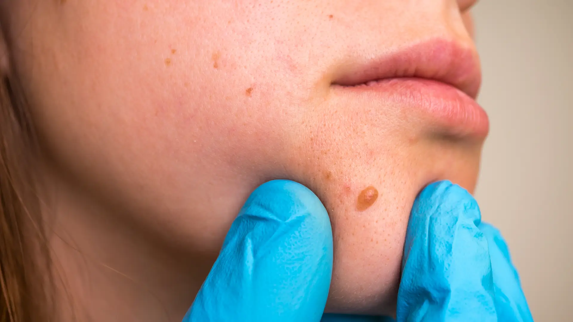 skin tag removal