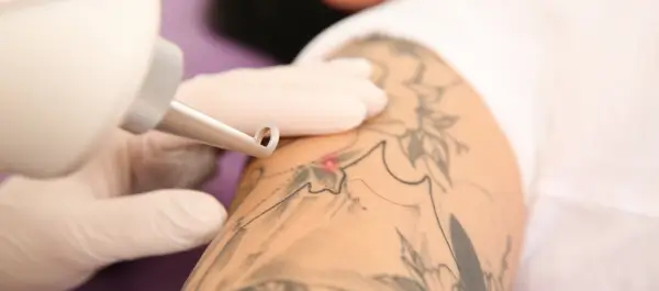 tattoo-removal-with-qwitched-laser